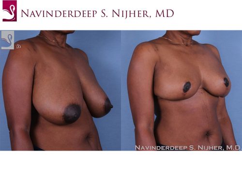 Female Breast Reduction Case #60954 (Image 2)