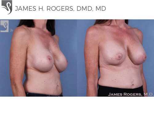 Breast Revisions Case #61009 (Image 2)