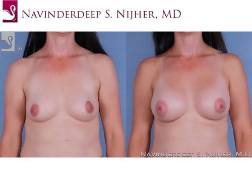 Breast Augmentation Case #61852 (Image 1)