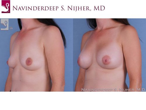Breast Augmentation Case #61852 (Image 2)