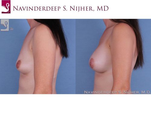 Breast Augmentation Case #61852 (Image 3)