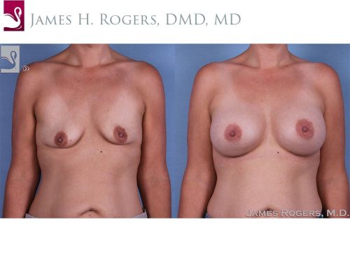 Breast Augmentation Case #62324 (Image 1)
