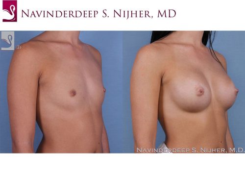 Breast Augmentation Case #62362 (Image 2)