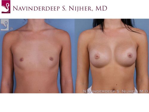 Breast Augmentation Case #62362 (Image 1)