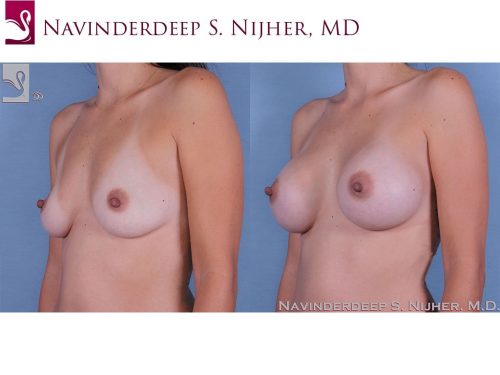 Breast Augmentation Case #62465 (Image 2)