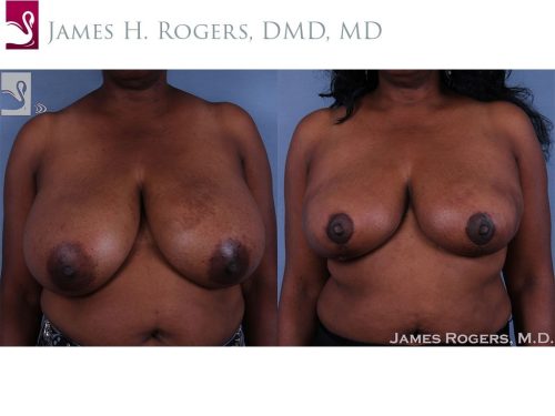 Female Breast Reduction Case #62515 (Image 1)