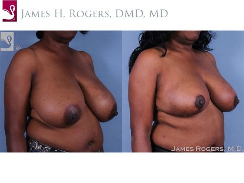 Female Breast Reduction Case #62515 (Image 2)