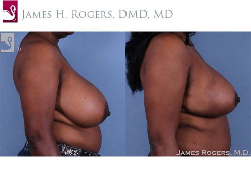 Female Breast Reduction Case #62515 (Image 3)