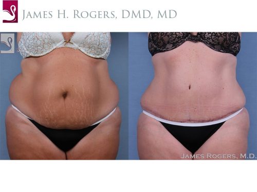 Before and after image of a real plastic surgery procedure performed by Dr. Rogers.