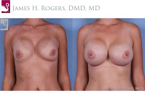 Breast Revisions Case #62755 (Image 1)