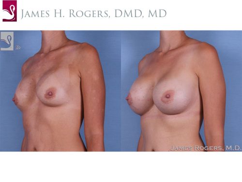 Breast Revisions Case #62755 (Image 2)