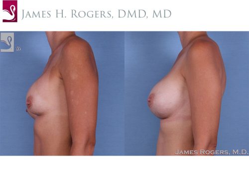 Breast Revisions Case #62755 (Image 3)