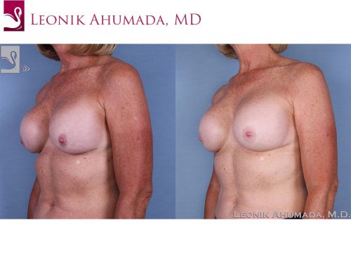 Breast Revisions Case #62979 (Image 2)