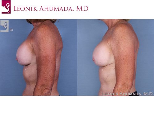 Breast Revisions Case #62979 (Image 3)