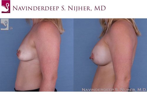 Breast Augmentation Case #63003 (Image 3)