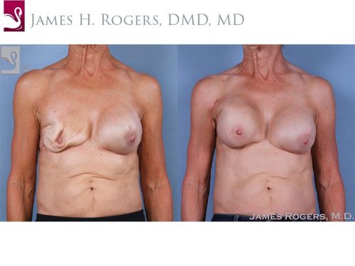 Breast Reconstruction Case #63441 (Image 1)