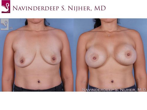 Breast Augmentation with Mastopexy (Breast Lift) Case #63688 (Image 1)