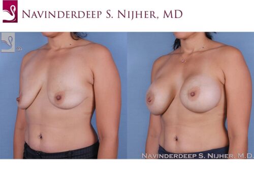 Breast Augmentation with Mastopexy (Breast Lift) Case #63688 (Image 2)