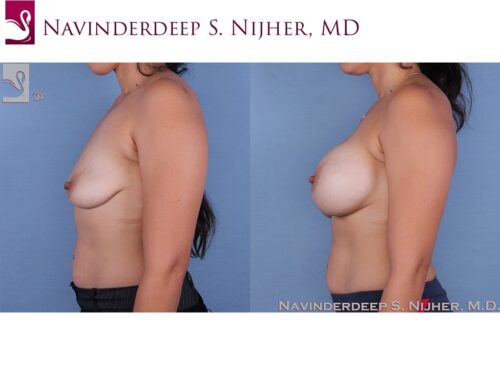 Breast Augmentation with Mastopexy (Breast Lift) Case #63688 (Image 3)