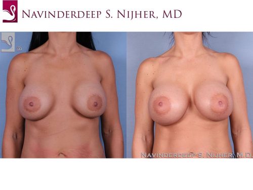 Breast Revisions Case #40792 (Image 1)