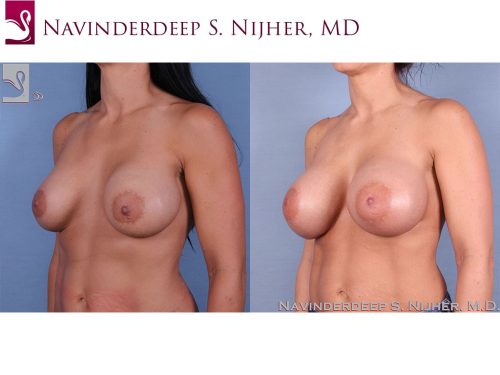 Breast Revisions Case #40792 (Image 2)