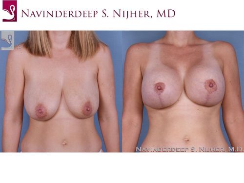 Breast Augmentation with Mastopexy (Breast Lift) Case #54067 (Image 1)