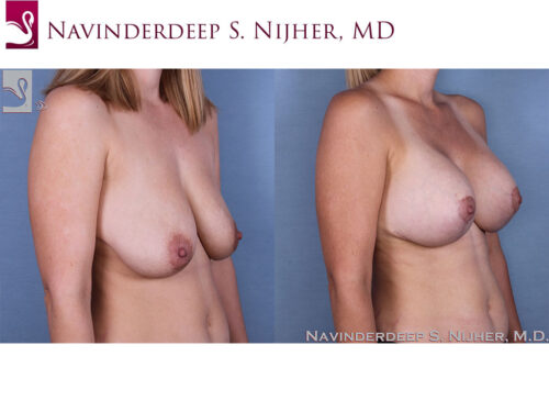 Breast Augmentation with Mastopexy (Breast Lift) Case #54067 (Image 2)
