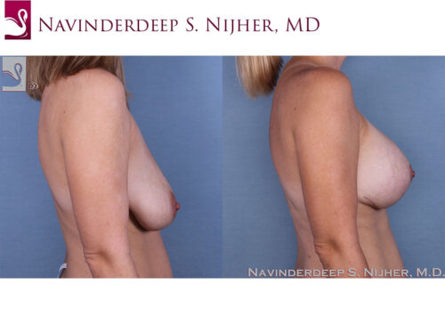 Breast Augmentation with Mastopexy (Breast Lift) Case #54067 (Image 3)