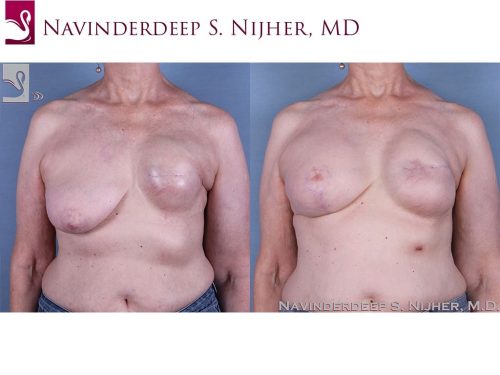 Breast Reconstruction Case #62069 (Image 1)