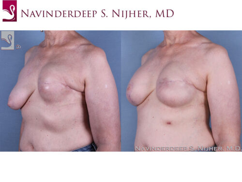 Breast Reconstruction Case #62069 (Image 2)