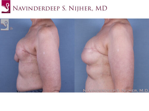 Breast Reconstruction Case #62069 (Image 3)