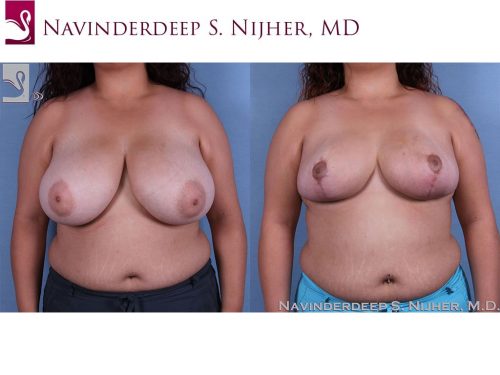 Female Breast Reduction Case #62312 (Image 1)