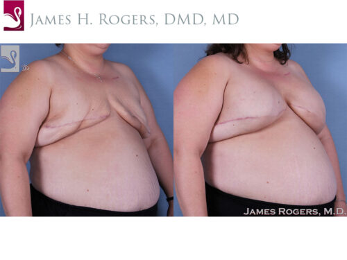 Breast Reconstruction Case #30932 (Image 2)