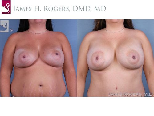 Breast Revisions Case #62794 (Image 1)
