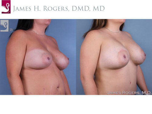Breast Revisions Case #62794 (Image 2)
