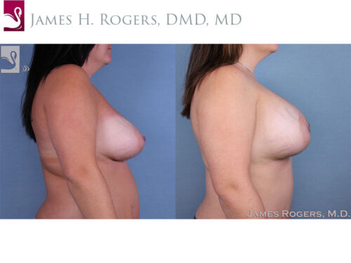 Breast Revisions Case #62794 (Image 3)