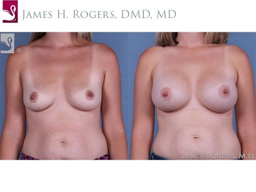 Breast Augmentation Case #62978 (Image 1)