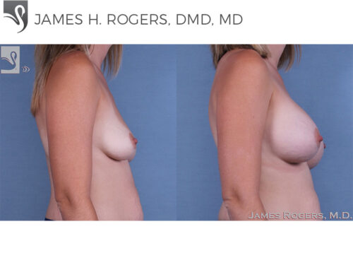 Breast Augmentation Case #62978 (Image 3)