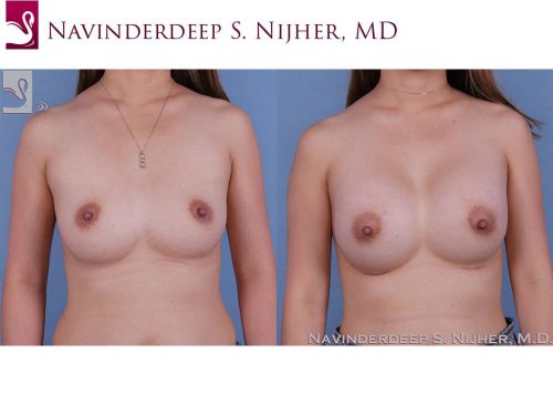 Breast Augmentation Case #63190 (Image 1)