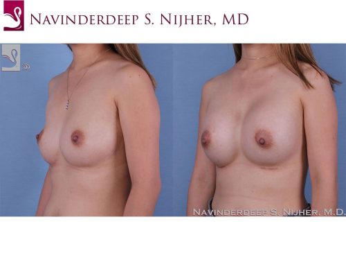 Breast Augmentation Case #63190 (Image 2)