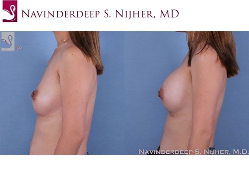 Breast Augmentation Case #63190 (Image 3)