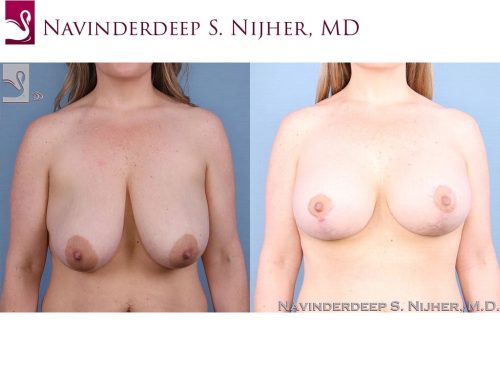 Breast Augmentation with Mastopexy (Breast Lift) Case #63414 (Image 1)
