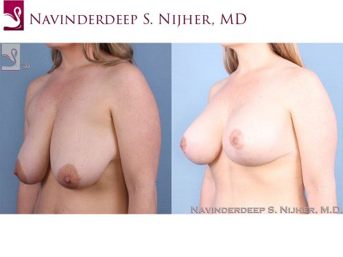 Breast Augmentation with Mastopexy (Breast Lift) Case #63414 (Image 2)