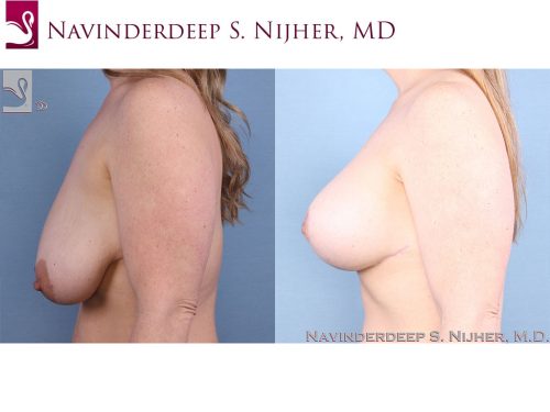 Breast Augmentation with Mastopexy (Breast Lift) Case #63414 (Image 3)