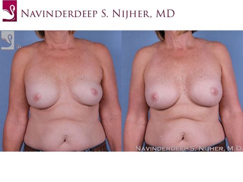 Breast Revisions Case #63645 (Image 1)