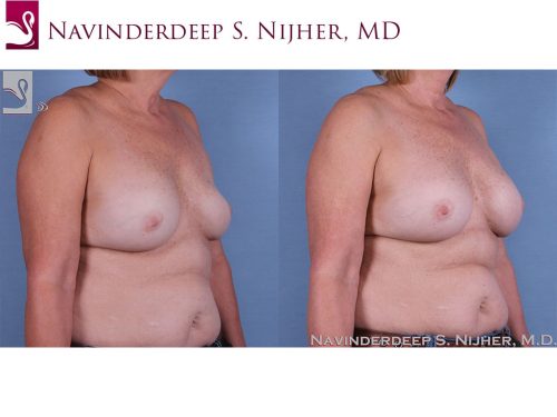 Breast Revisions Case #63645 (Image 2)