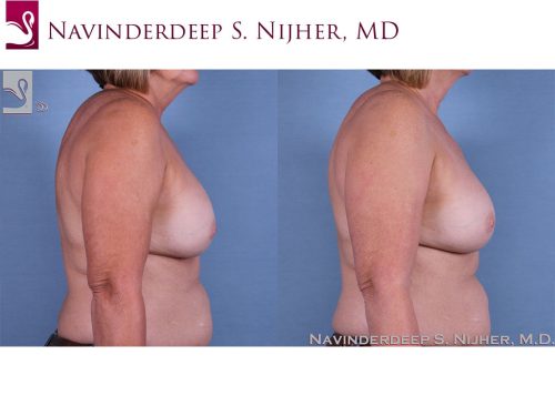 Breast Revisions Case #63645 (Image 3)