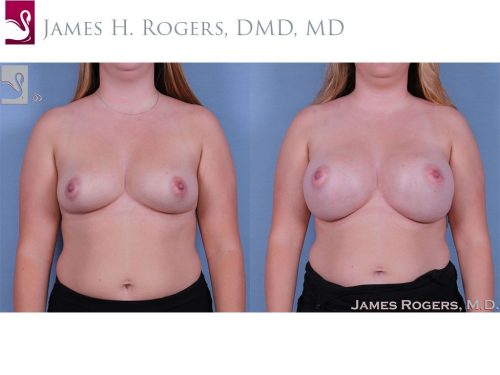 Breast Augmentation Case #63850 (Image 1)