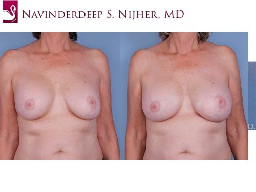 Breast Revisions Case #12241 (Image 1)