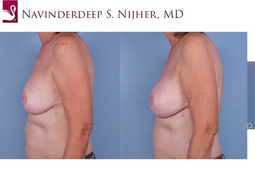 Breast Revisions Case #12241 (Image 3)